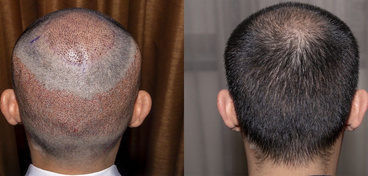 Türkei etabliert sich als führendes Ziel für Haartransplantationen (Foto: AdobeStock - Sugrit - 290465761)